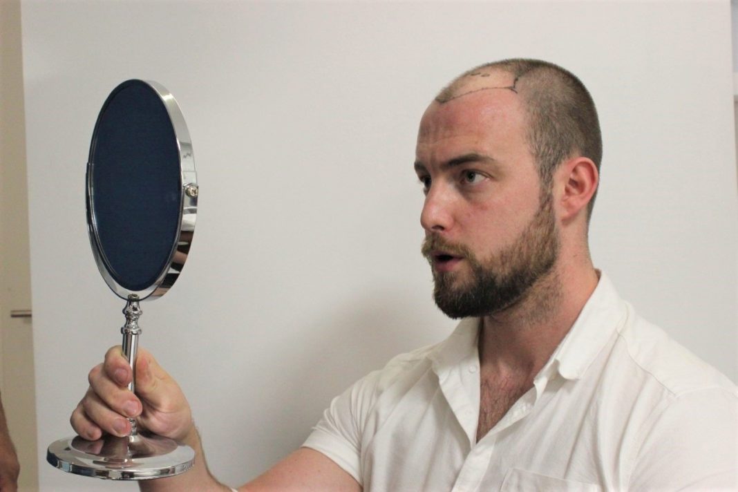 how-turkey-attracts-hair-transplant-patients-to-the-country