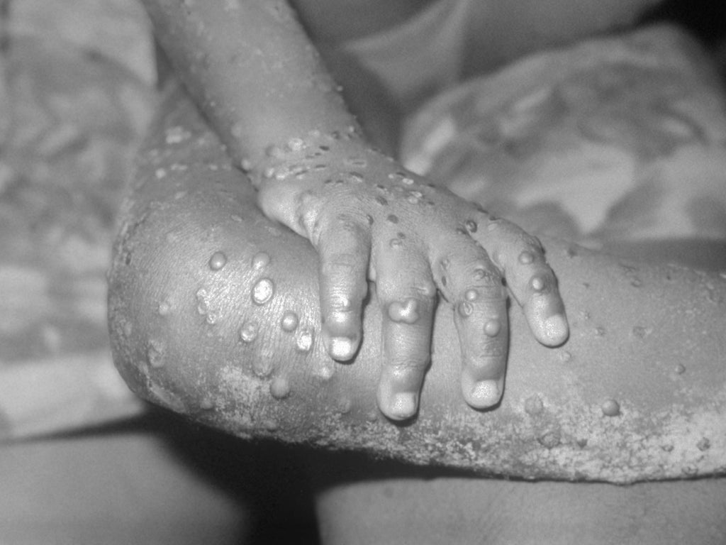 uk-monkeypox-outbreak-‘unprecedented’-as-officials-say-sexual-contact-likely-route-of-transmission