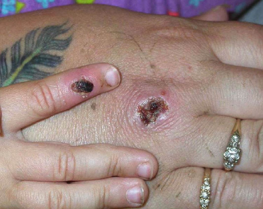 uk-monkeypox-outbreak-‘won’t-be-easy-to-stamp-out’-and-could-last-for-months,-leading-scientist-warns
