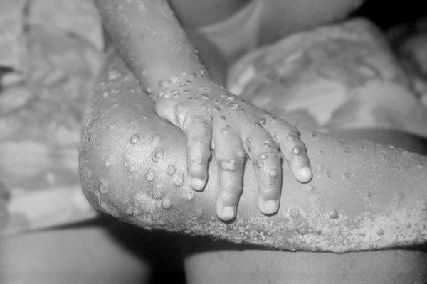 monkeypox-outbreak-reveals-familiar-failings-in-global-health-strategy